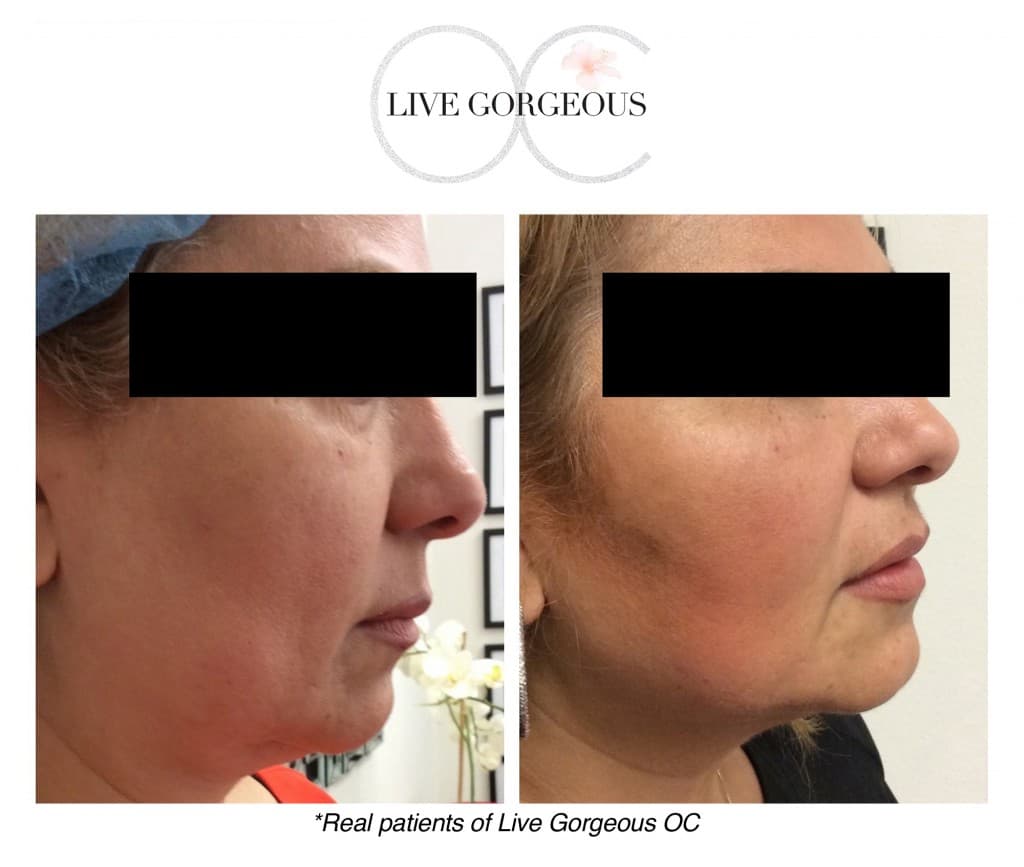 Microneedling at YOUNG — 1