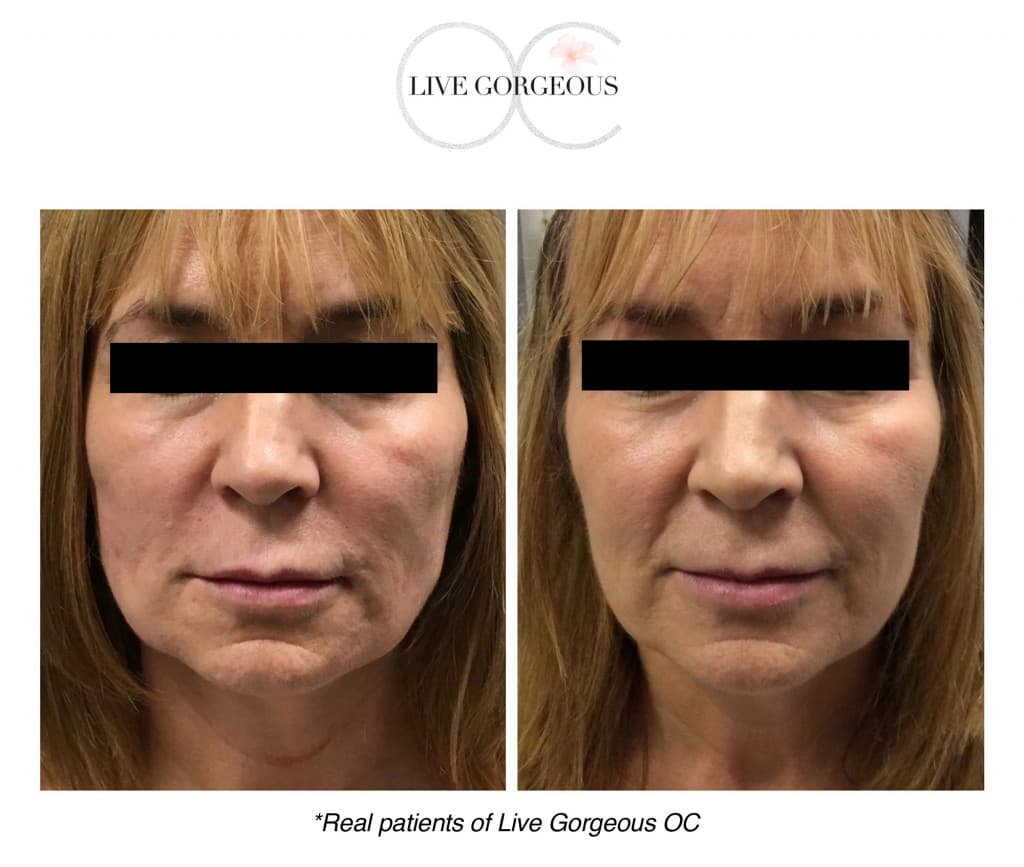 Microneedling at YOUNG — 2