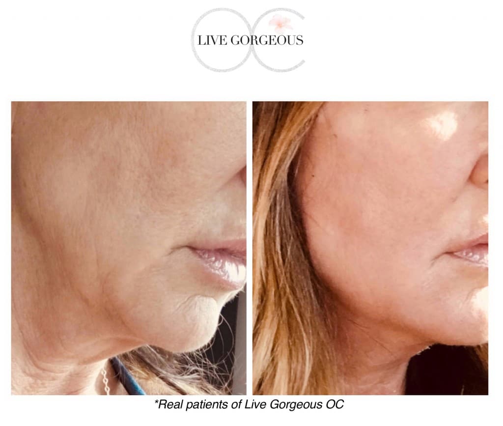 Microneedling at YOUNG — 3