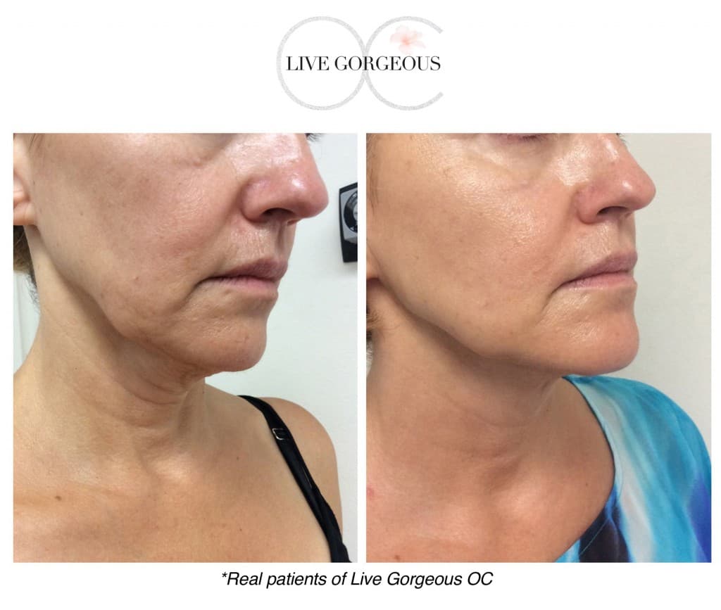 Microneedling at YOUNG — 4