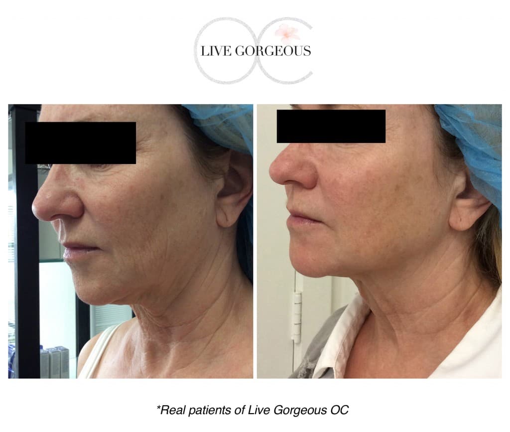 Microneedling at YOUNG — 5