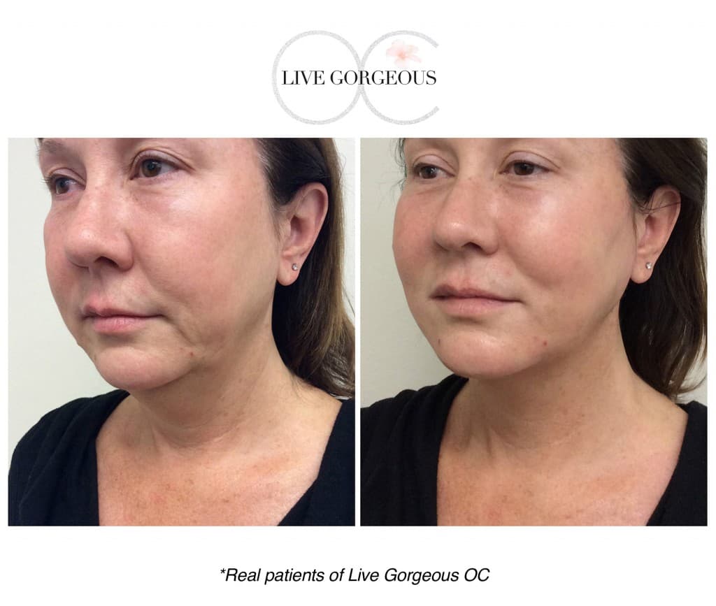 Microneedling at YOUNG — 6