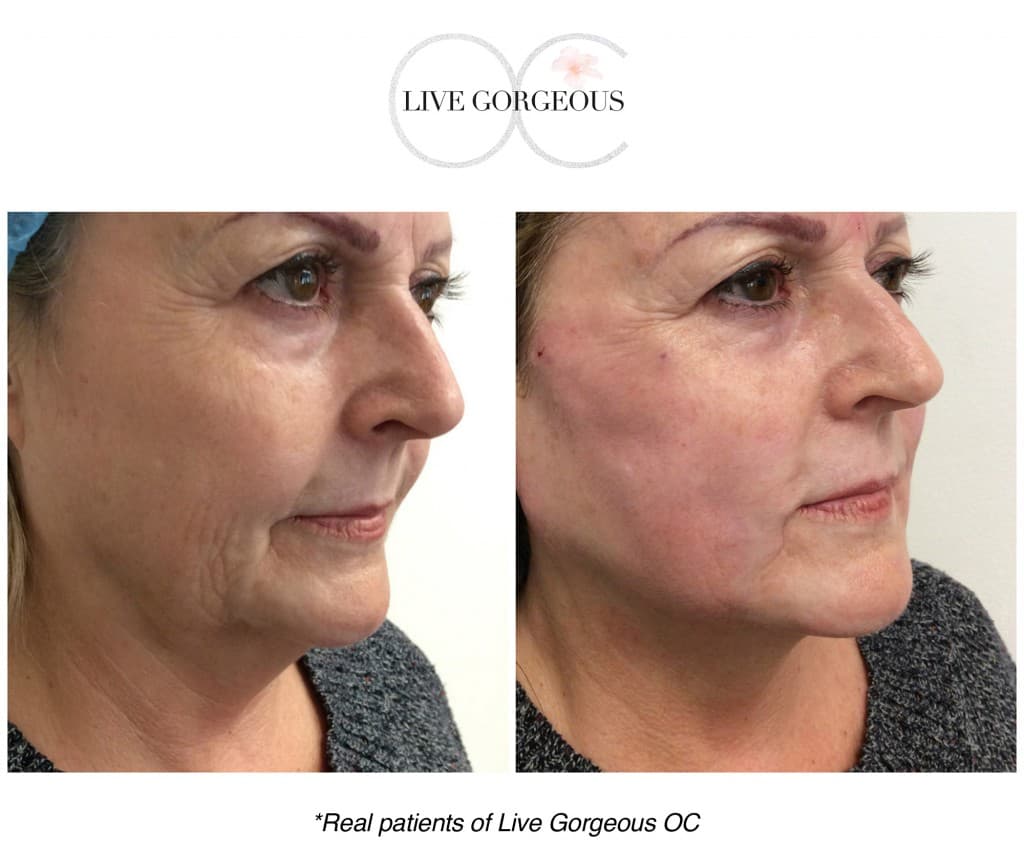 Microneedling at YOUNG — 7