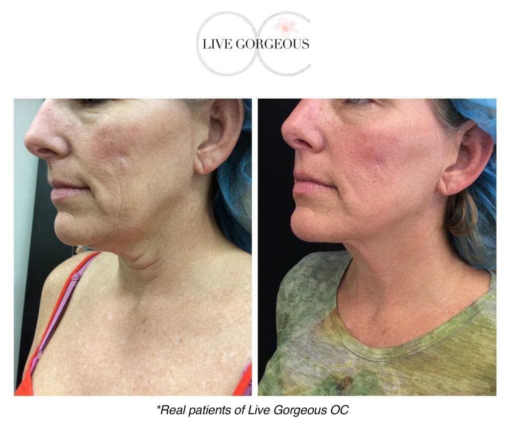 Microneedling at YOUNG — 9