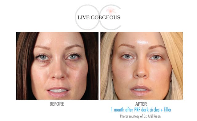 PRF therapy at YOUNG — 1
