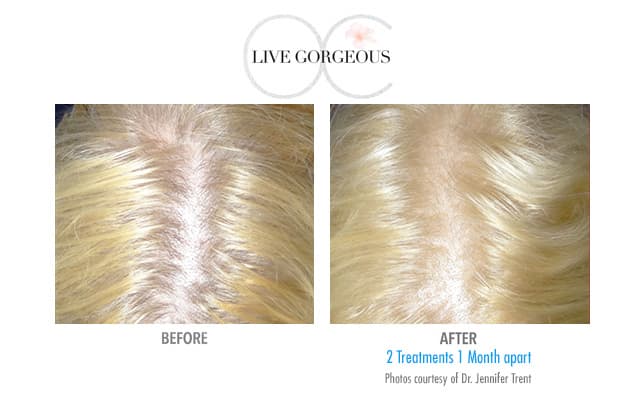 PRF therapy at YOUNG — 3