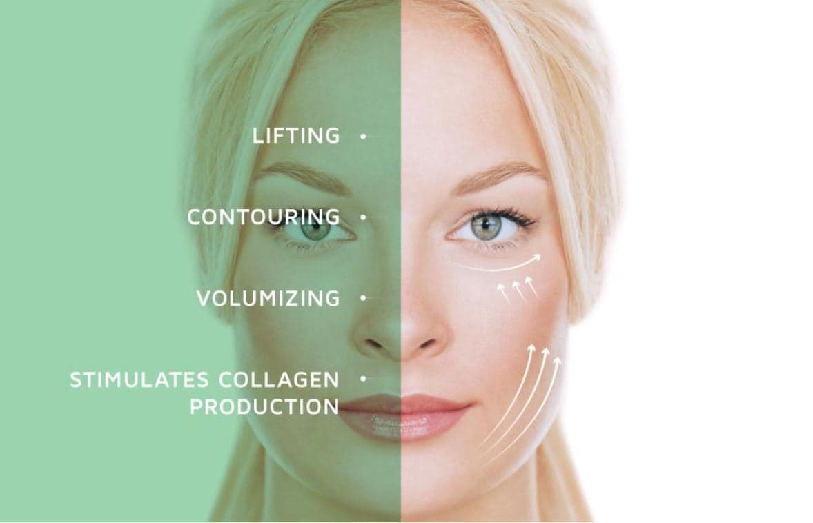 Non-surgical face lift — PDO threadlift at YOUNG