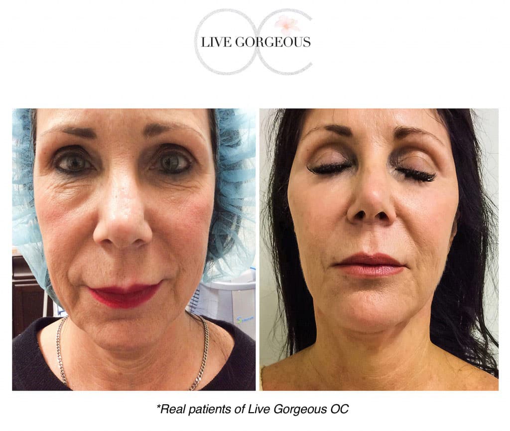 PDO threadlift result at YOUNG — 1