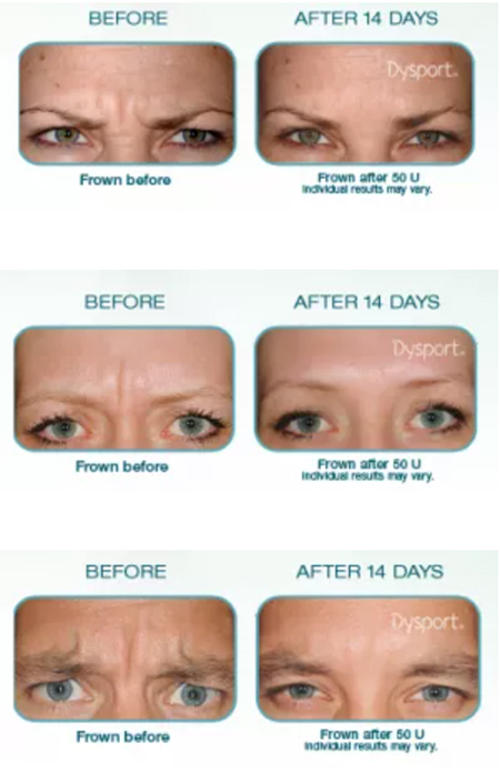 Dysport